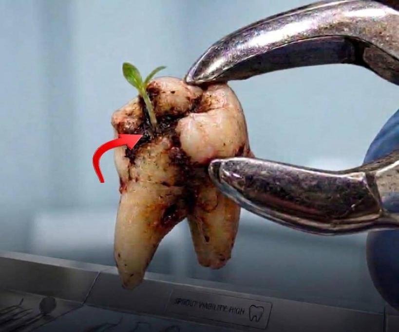 هل يمكن أن تنمو نبتة داخل سنّ متسوّس؟