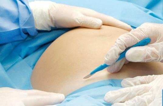 مصر.. الحد من الولادات القيصرية