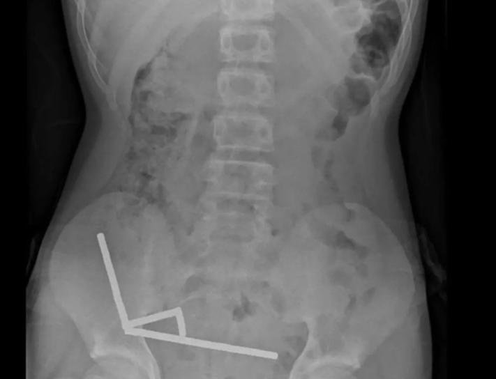 اشتراها عبر الإنترنت وابتلعها.. إزالة 100 مغناطيس من أمعاء "قاصر" في نيوزيلندا