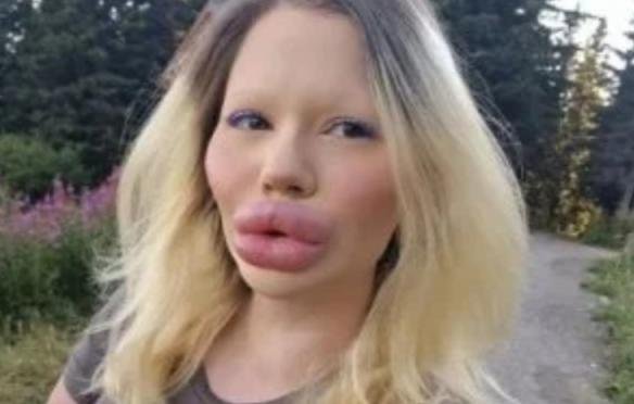 خضعت لـ 32 حقنة تكبير.. بلغارية تتعرض للسخرية بسبب شفتيها