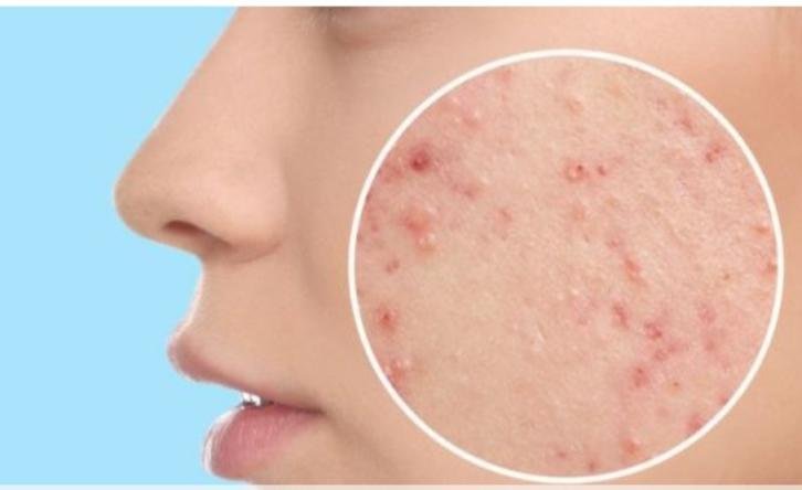 للوقاية من حَب الشباب.. هناك أطعمة يجب عليكي تجنبها