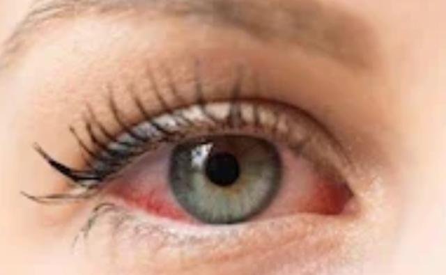 قبل تفاقمها..  “حساسية العين”  متى تستدعي زيارة الطبيب؟