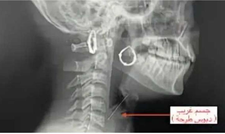 مصر..  «دبوس طرحة» كاد يودي بحياة شابة في بنها