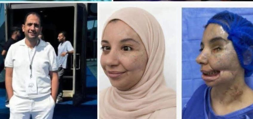 في إنجاز طبي نادر.. جراح مصري يعيد ملامح وجه فتاة من غزة