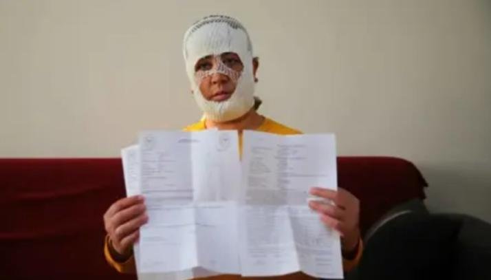 جميلة تركية تخسر وجهها بسبب عملية تجميل فاشلة