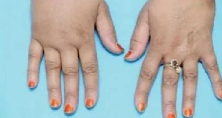 "الوذمة اللمفية عند السيدات" الأسباب وطرق العلاج؟!