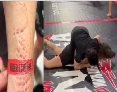 خلال مباراة رسمية.. لاعبة جوجتسو "تعض" منافستها بطريقة وحشية