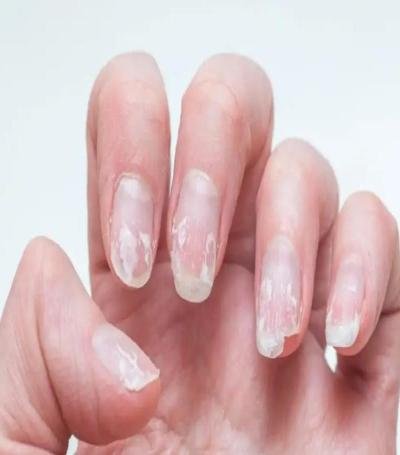 هشاشة الاظافر تؤدي إلى مشاكل صحية خطيرة