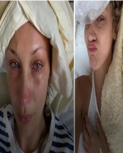 بيلا حديد تكشف معاناتها مع مرض "لايم"