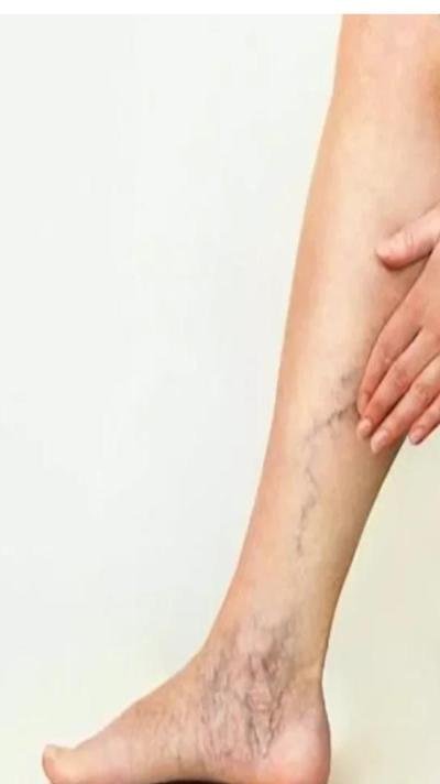 الدوالي متى تحتاج  إلى جراحة