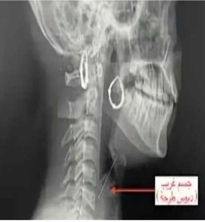 مصر..  «دبوس طرحة» كاد يودي بحياة شابة في بنها