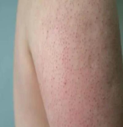 جلد ساقيك وذراعيك ك"جلد الدجاجة".. تعرف على السبب؟