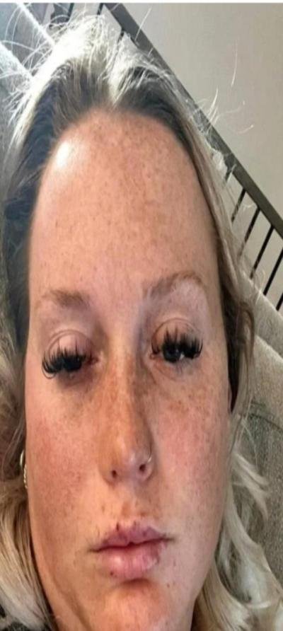 البوتوكس.. تحذيرات خطيرة بعد إصابة امرأة بالشلل بسبب حقنة تجميلية